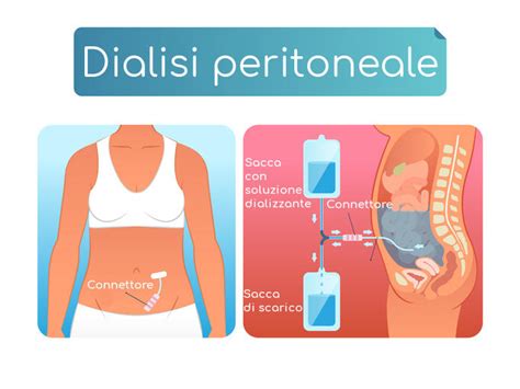schema del sistema di dialisi peritoneale