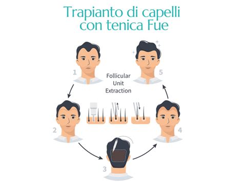 Confronto tra tecnica FUT e FUE per il trapianto di capelli