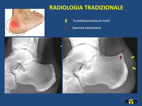 Schema della deformità di Haglund con protuberanza ossea e infiammazione della borsa retrocalcaneare
