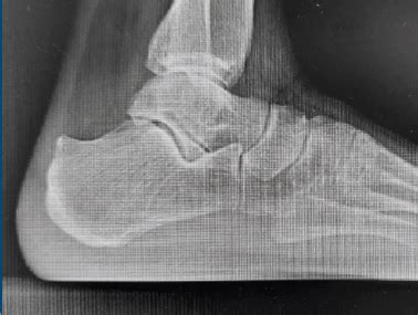 Immagine radiografica che mostra la deformità di Haglund