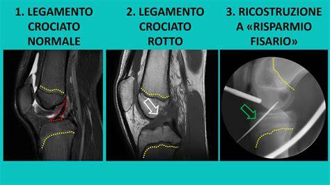 Radiografia di un ginocchio con lesione del legamento crociato anteriore