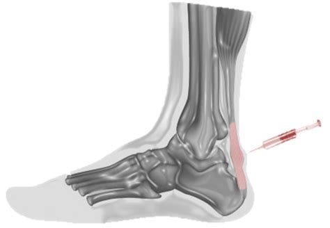 Infiltrazione PRP per trattamento tendine d'Achille